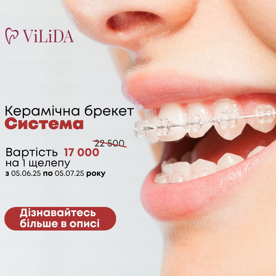 Акція на керамічні брекети у Vilida!